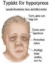 Är håravfall orsakat av hypotyreos reversibelt?