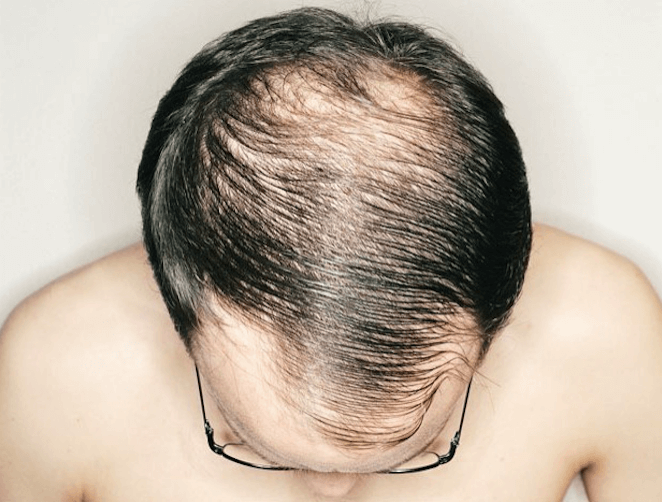 Vanliga frågor om tunnhårighet och hårbortfall